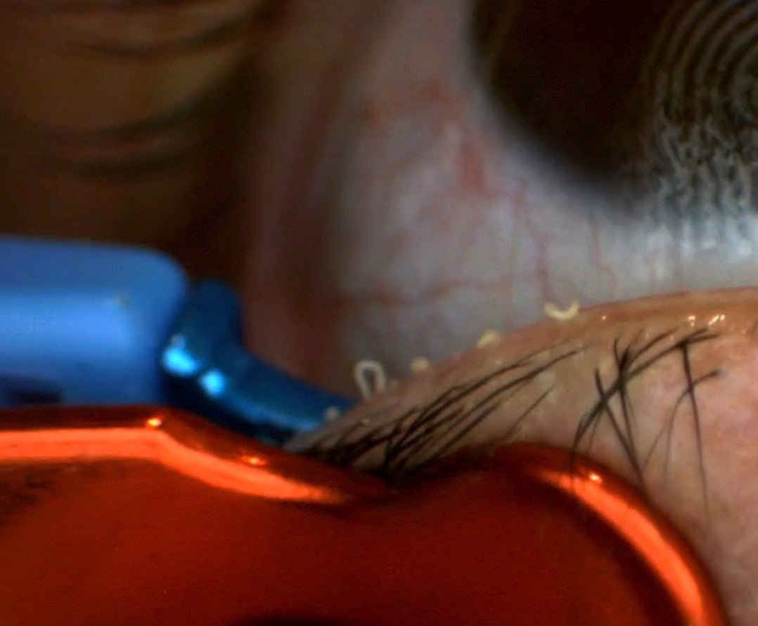 MGrx Dry Eye Treatment System - No Disposables!