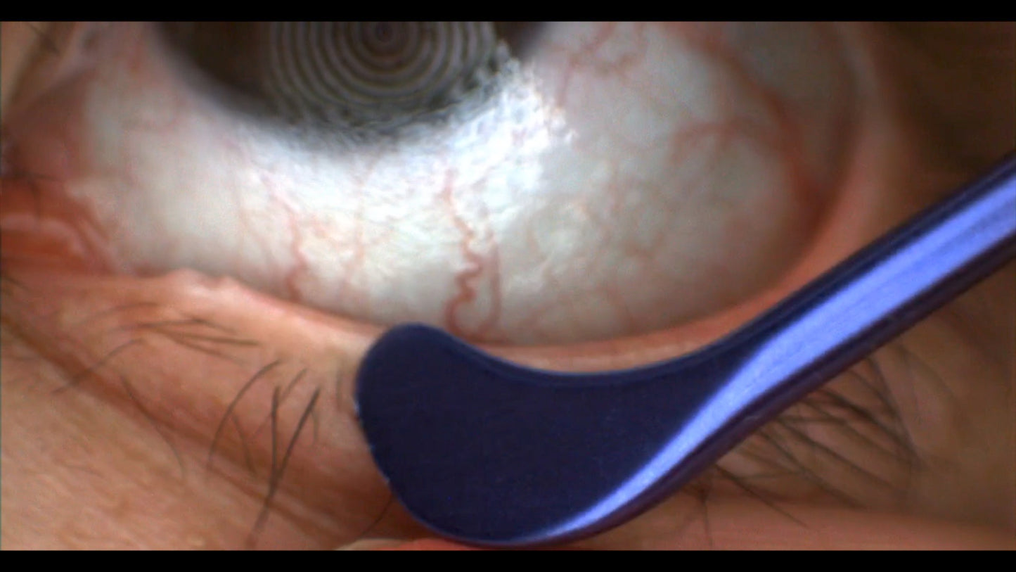 MGrx Dry Eye Treatment System - No Disposables!