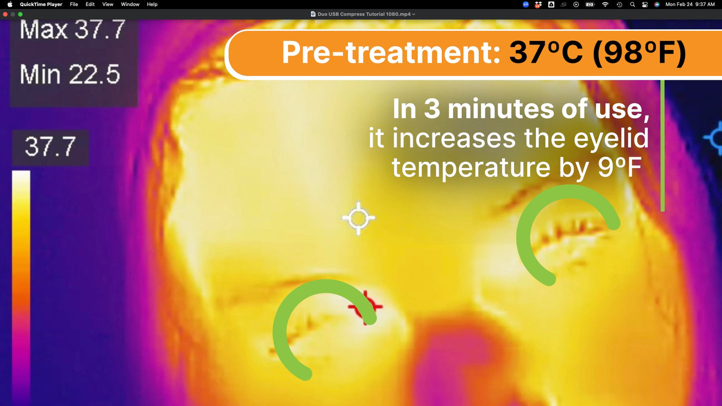 Trial Dry Eye Protocol - 10 Treatments (Duo USB + UltraLid Pro)